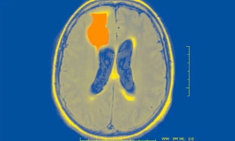 Los pronósticos de crisis epilépticas podrían convertirse en realidad 1 Los pronósticos de crisis epilépticas podrían convertirse en realidad