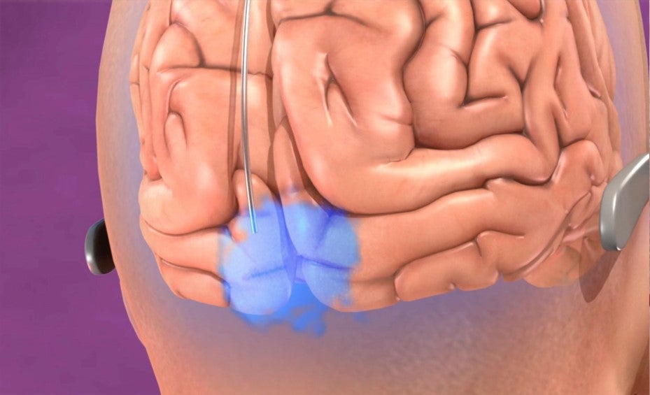 Un nuevo tipo de prótesis visual 2 1659547171 331 Un nuevo tipo de protesis visual