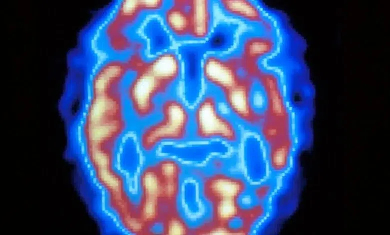 Herramienta de IA podría ayudar a diagnosticar el Alzheimer 1 Herramienta de IA podría ayudar a diagnosticar el Alzheimer