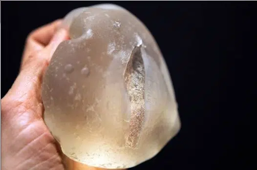 Los implantes mamarios PIP advierten que llegarán a Oriente Medio 1 ruptured pip breast implant france