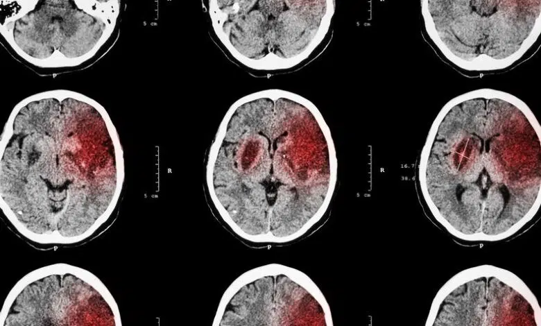 Apuntar a la inflamación protege y restaura el cerebro después de un accidente cerebrovascular 1 Apuntar a la inflamación protege y restaura el cerebro después de un accidente cerebrovascular
