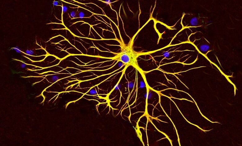 El autismo comparte características cerebrales con la esquizofrenia y el trastorno bipolar 1 El autismo comparte características cerebrales con la esquizofrenia y el trastorno bipolar