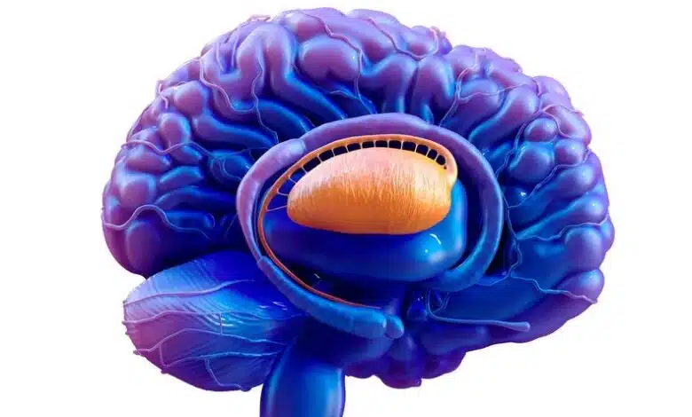 La terapia experimental de Huntington se muestra prometedora en un pequeño ensayo 1 La terapia experimental de Huntington se muestra prometedora en un pequeño ensayo