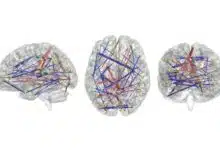 Los escáneres cerebrales pueden predecir el autismo en los bebés