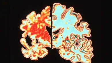 ¿Podría la estimulación cerebral magnética ayudar a los pacientes de Alzheimer?