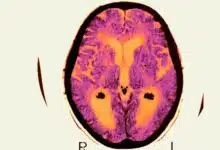 El ensayo fallido de Alzheimer no acabó con la teoría principal de la enfermedad