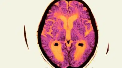 El ensayo fallido de Alzheimer no acabó con la teoría principal de la enfermedad