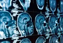 Un estudio sobre accidentes cerebrovasculares genera llamados para revisar los planes de atención de emergencia