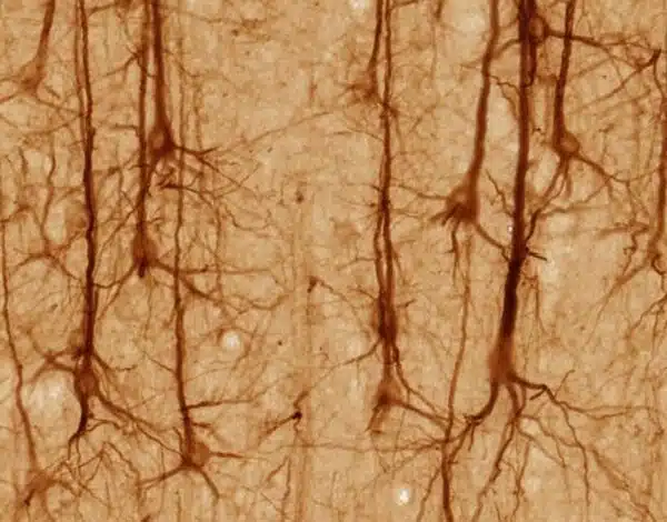 Cómo una extraña condición resuelve un misterio de la neurociencia 1 Cómo una extraña condición resuelve un misterio de la neurociencia