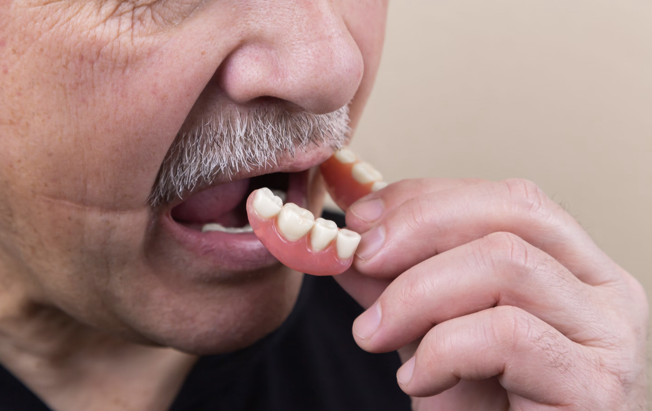 ¿Cepillarse los dientes y usar brackets de plástico genera microplásticos? 5 ¿Microplásticos en dentaduras postizas?